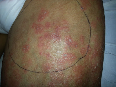 Atopichesky la dermatitis solamente sobre la persona